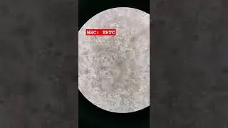 White blood cells in urine Urinary Tract infection under the microscope 