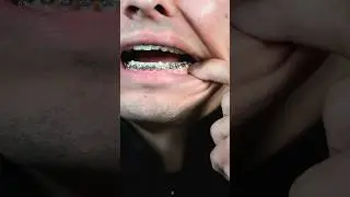 385 Days with Braces 🤯