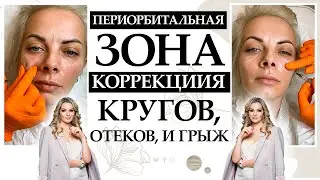 Periorbital Zone. Периорбитальная зона. Алгоритм коррекции темных кругов, отеков и грыж.