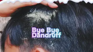 Bye Bye Dandruff: Easy & Effective Removal Tips!