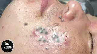 Removal of giant blackheads and pimples!