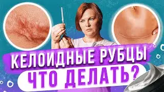 Келоидные рубцы. Что точно не стоит делать?