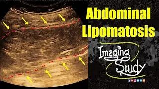 Abdominal Lipomatosis || Ultrasound || Case 350