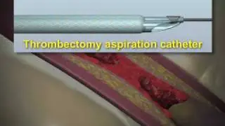 NEJM Procedure: Thrombus Aspiration
