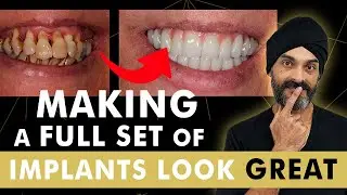 How we make a full set of Dental Implants (all on 4) look great