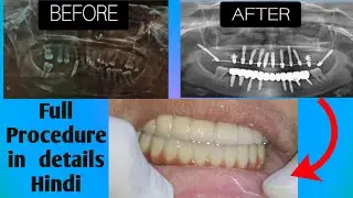 Get Full Mouth Dental Implant and Fix Teeth Navi Mumbai || Dental implant procedure||