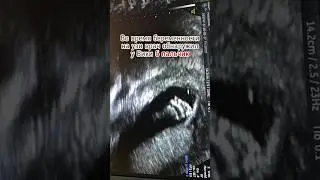 Врач обнаружил 6 пальчик на узи во время беременности. Тогда я сильно переживала, ещё не зная...