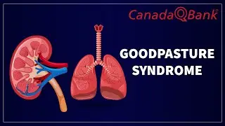 Goodpasture Syndrome