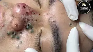 Very Satisfactory | Removal of giant blackheads and pimples!