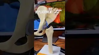 Top Lies About Hip Replacement Surgery 👇 #shorts