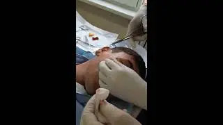 Operation to remove atheroma on the face 👌🔥