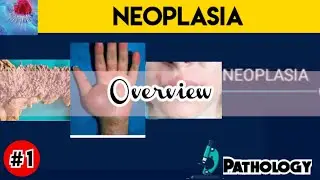 Neoplasia Pathology - introduction