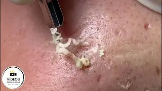 Very Satisfactory | Removal of blackheads and whiteheads
