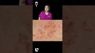 👩🏻🩺Cathy explains what petechiae are, and causes of petechiae: Medical Surgical SHORT | 