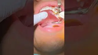 What happened to the hole in my tooth? 😭