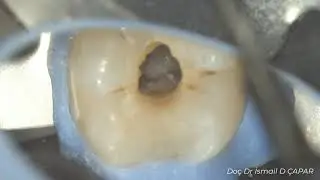 Alt molar dişlerde konservatif giriş kavitesi ve kanalların bulunması