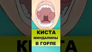 КИСТА МИНДАЛИНЫ В ГОРЛЕ