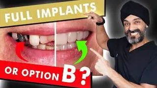 All on 4 or Another Way to Have a Full Set of Dental Implants?