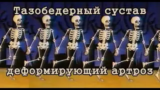 Тазобедерный сустав, деформирующий артроз. (девяностые, реклама 90-х)