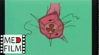 Replacement of the aortic valve allografts ©