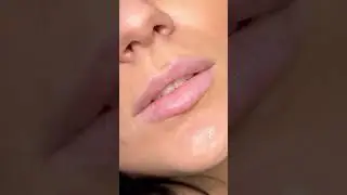 Увеличение губ. Запись на все обучающие программы ➡️ inst:dr.antonina_guz