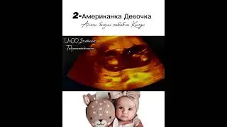МАЛУМОТ УЧУН ФАКАТ ТЕЛЕГРАМДАН ЁЗИНГ: +998950014004 #Узи #беременность #гинекология #Хомиладорлик