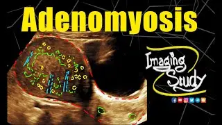 Adenomyosis | Uterus || Ultrasound || Case 330