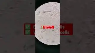 White blood cells and Epithelial cells in urine under the microscope 