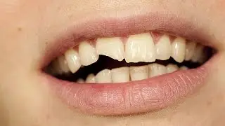 Dişim Kırıldı Ne Yapmalıyım?
