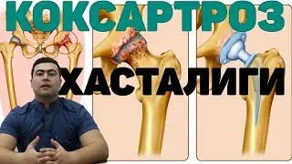 КОКСАРТРОЗ ХАСТАЛИГИ КЕЛИБ ЧИКИШ САБАБЛАРИ ДАВО ЧОРАЛАРИ | KO`KSARTROZ XASTALIGI HAQIDA BATAFSIL