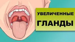 УВЕЛИЧЕННЫЕ ГЛАНДЫ – о чем это говорит?