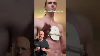 Pigeon Chest Deformity 