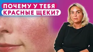 Покраснение лица // РОЗАЦЕА // Что с этим делать? #клиникащербатовой  #косметология  #розацеа