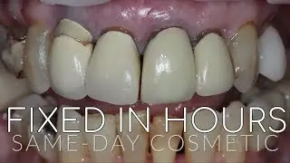 Amazing Smile Transformations and Makeovers -  Cosmetic Veneers, Invisalign, and Dental Implants