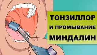 ПРОМЫВАНИЕ МИНДАЛИН ТОНЗИЛЛОРОМ: особенности процедуры