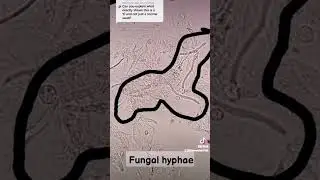 Yeast cells and Fungal hyphae seen on Vaginal swab sample under the microscope 