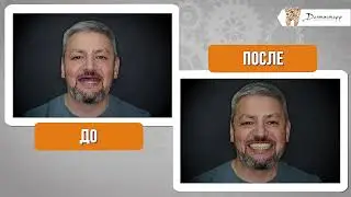 Имплантация зубов отзывы 👍 пациент стоматологии Дантистофф