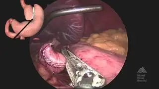 THE MOUNT SINAI SURGICAL FILM ATLAS Laparoscopic Roux en Y Gastric Bypass