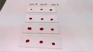 Blood typing(Rh positive) slide agglutination test |MEDICAL LABORATORY SCIENCE