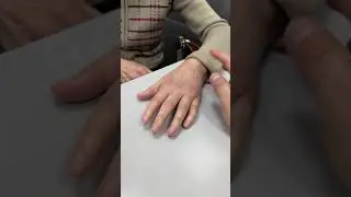 ГИПС ДВА МЕСЯЦА - Перелом лучевой кости - Последствия