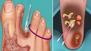 ASMR | Mengobati Luka Bakar & Jamur Pada Kaki #asmr