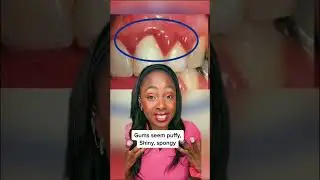 3 signs that YOU have gum disease 