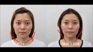 【小顔・顔の歪み矯正】非常にソフトな矯正でフェイスラインがスッキリ！埼玉県川越市宮崎整体院