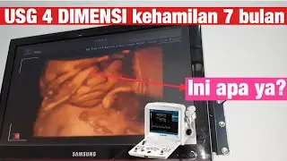USG 4 Dimensi ( 4D ) Kandungan 7 Bulan . Wajah dan kelamin terlihat jelas