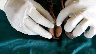 Testes - anatomical postion / side/ applied anatomy/ relation