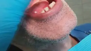 Пациент "Б". Бюгельные протезы (архивное видео от 20.06.2023). 4-я стоматология.