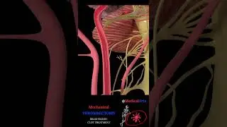 Mechanical Thrombectomy Stroke Animation 