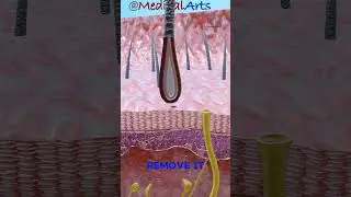 Blackhead video ⚫ Blackhead formation 