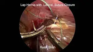 LAPAROSCOPIC REPAIR OF INGUINAL HERNIA WITH LATERAL SUTURE CLOSURE IN A 12 YEAR OLD BOY
