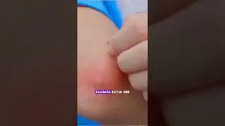 Kalau kamu sering minum obat alergi ini ga sih? Komen ya 